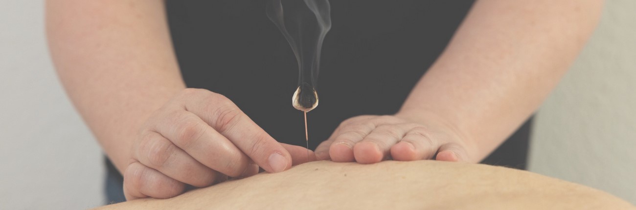 Eine Moxakegel aufgesteckt auf einer Akupunkturnadel wird auf der Haut eines Patienten abgebrannt.